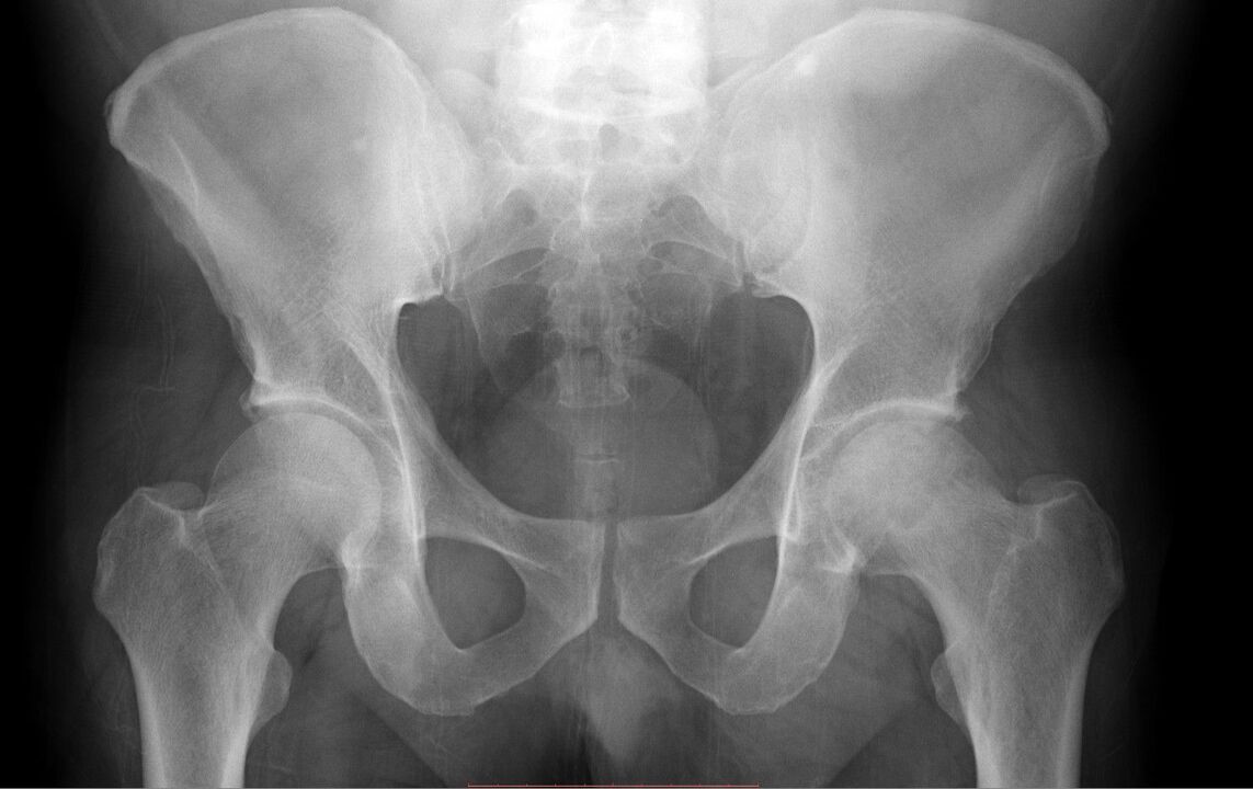 Diagnosis of hip joints