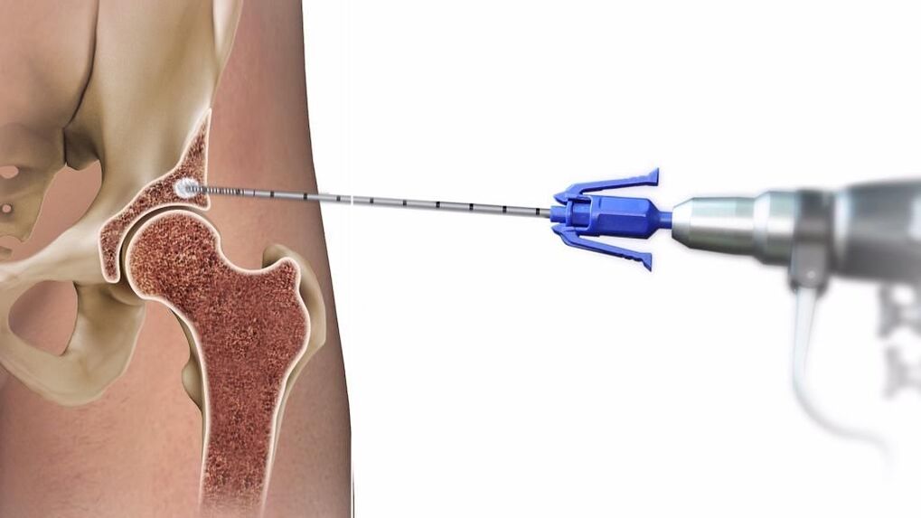 injections in the hip joint