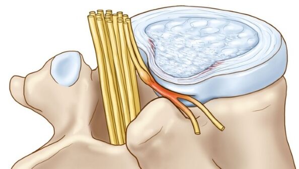 Intervertebral disc herniations that occur with thoracic osteochondrosis compress nerve endings
