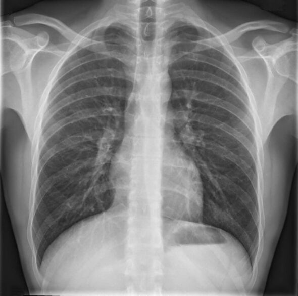Osteochondrosis of the thoracic spine is diagnosed using radiographs