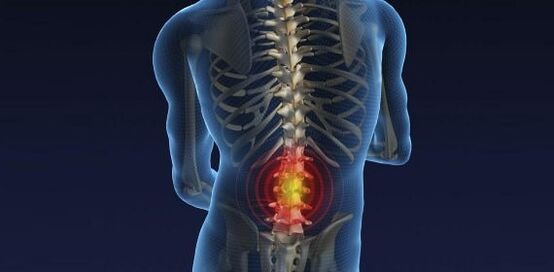 Back pain with lumbar osteochondrosis