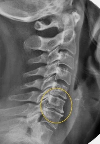 Osteochondrosis of the cervical spine in an X -ray