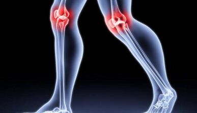 Preventing the development of arthritis and arthritis