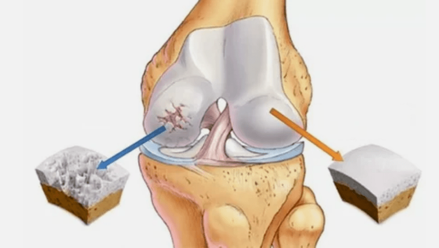 How arthrose develops