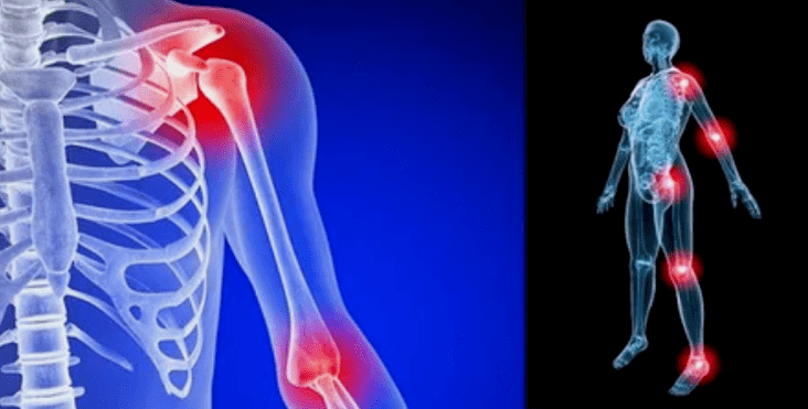 deformation of the limbs for arthritis