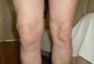 manifestations of osteoarthritis of the knee joints (1)
