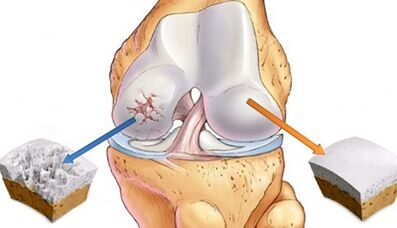 Causes of joint arthrosis