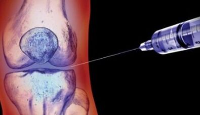 Methods of treatment of joint arthrosis