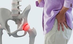 causes of hip arthrosis