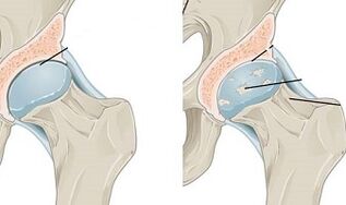 stages of development of hip osteoarthritis