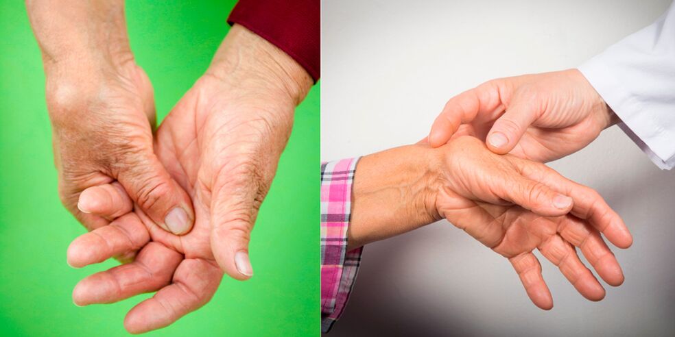 swelling and aching pain are the first signs of arthritis of the hands