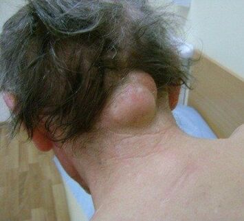 neoplasm as a cause of neck pain