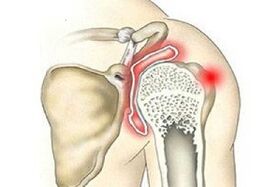 destruction of the shoulder joint with osteoarthritis