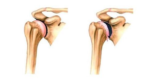 healthy and arthritic shoulder joints