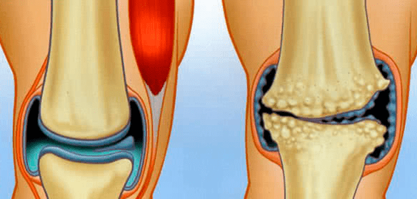 Normal and arthrosis joints